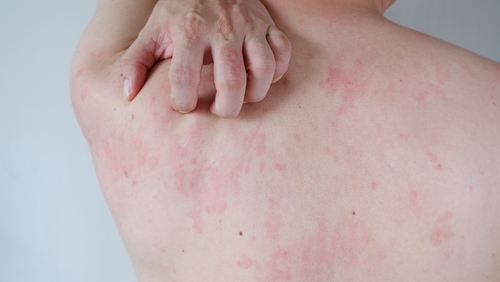 זולאייר במינון נמוך כטיפול בסרפדת (URTICARIA) כרונית